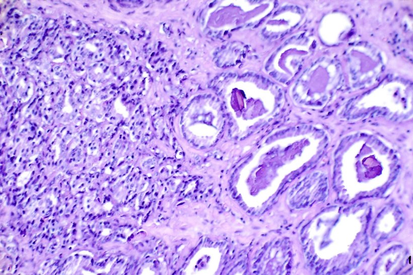 Histologischer Objektträger (H&E-Färbung bei x300) mit Prostatakrebs
