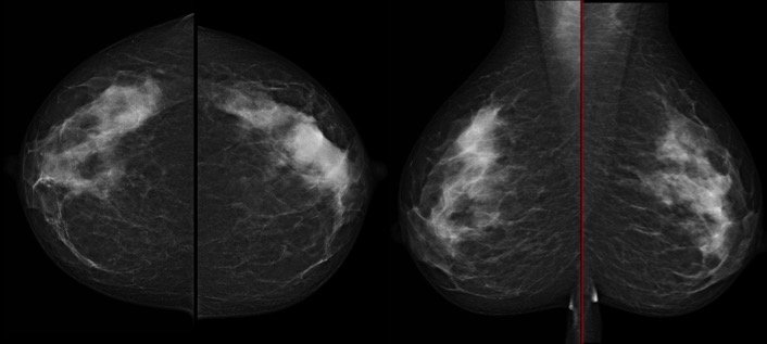 Bilateral mammography