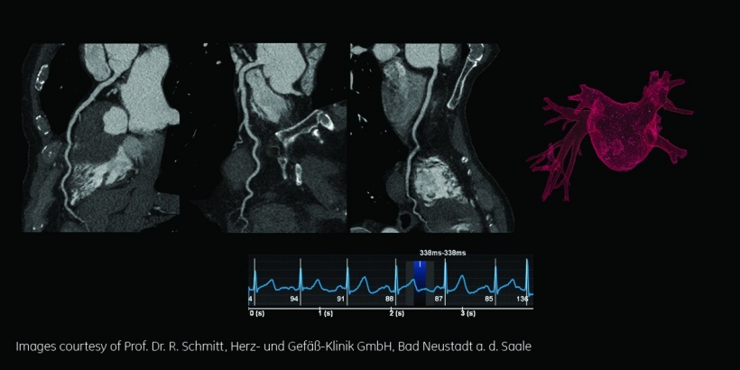 Pulmonalvenendarstellung bei Vorhofflimmern bei einer Herzfrequenz von 85-136...