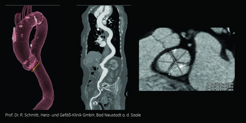 Schnelle und exakte TAVI-Planung mit dem Revolution CT.