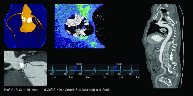 TAVI-Planung und CCTA in einem Scan und Kontrastmittelinjektion – unabhängig...