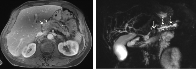Abb. links: Karzinom im Pankreaskopf (Pfeil) mit Erweiterung des peripheren...