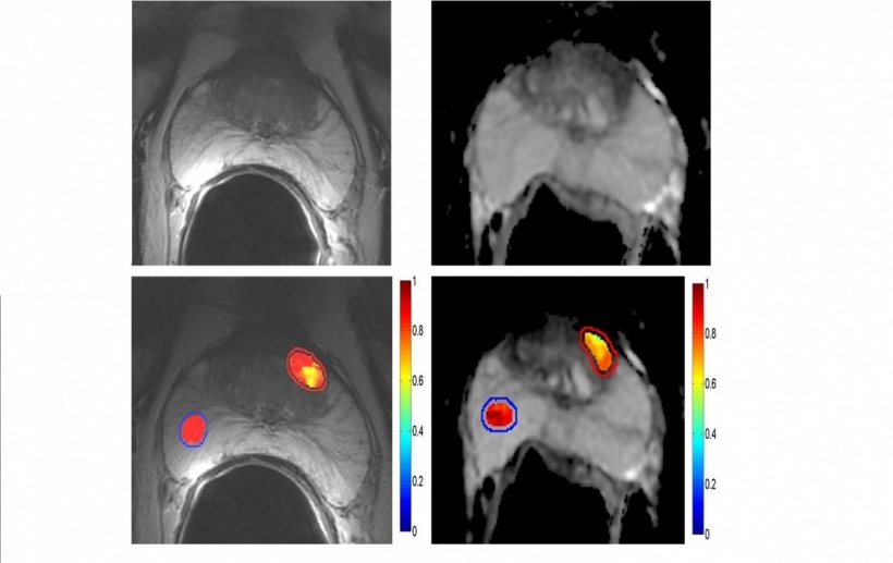 MR Imaging:
Tumor Detection/Aggressiveness.
Texture Analysis Compared to T2WI &...