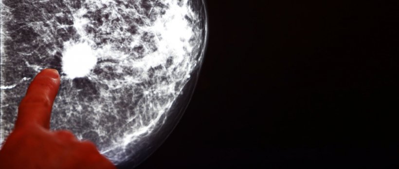 Brustkrebs: Risikobasiertes Screening ist kosteneffektiv