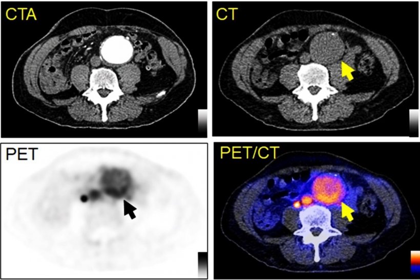 64Cu-DOTA-ECL1i PET/CT image of a patient with an abdominal aortic aneurysm....