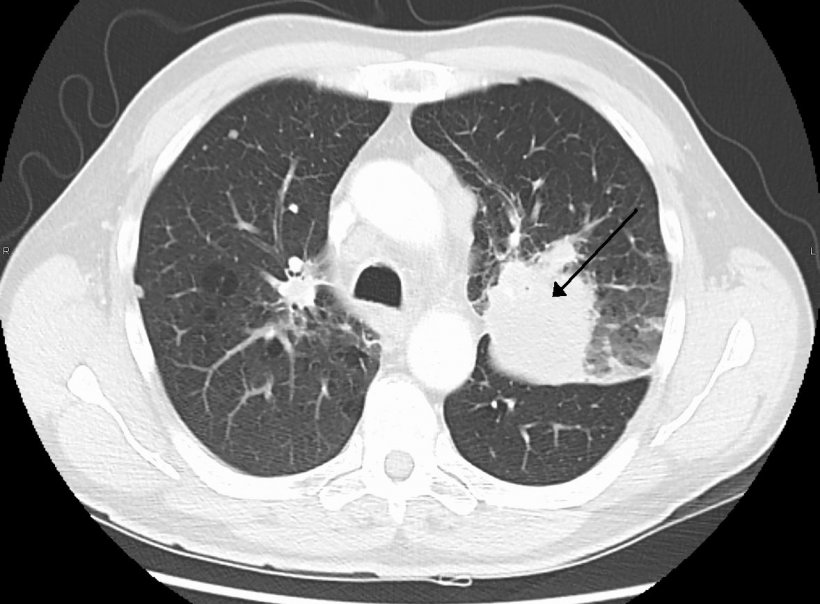 lung cancer on ct scan