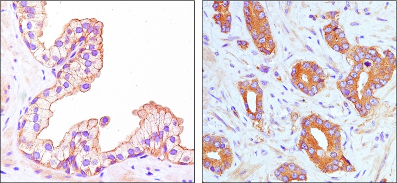 Left: AIM1 proteins are stained brown in normal prostate cells and are located...