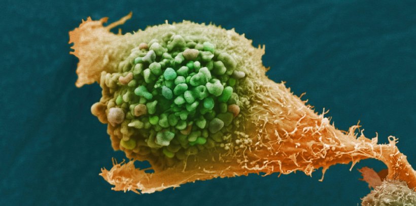 Prostate cancer cell (SEM image)
