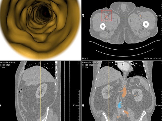 Fiberglass navigation during an endovascular aneurysm repair. (EVAR)