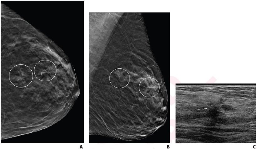A. Craniocaudal and B. mediolateral oblique digital breast tomosynthesis images...