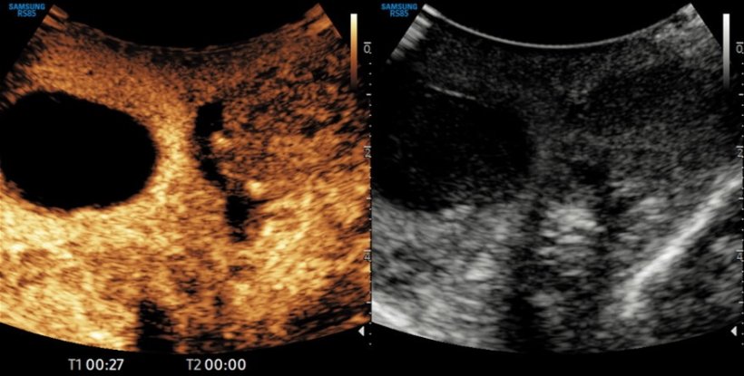 Image of a contrast enhanced testicular ultrasound demonstrating right...