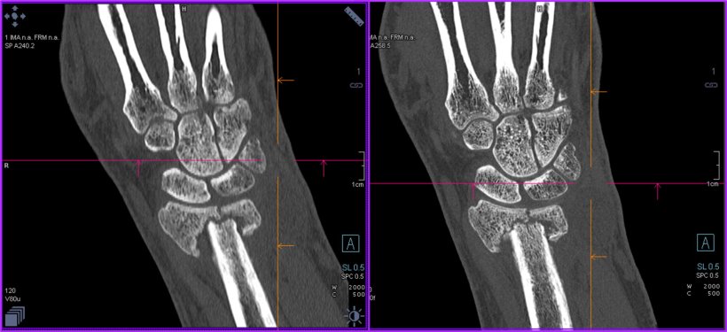 Patient with a broken wrist scanned on a conventional CT scanner (left) and a...