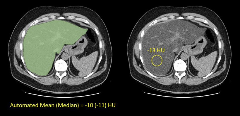 Images show automated and manual methods for measuring liver attenuation at...
