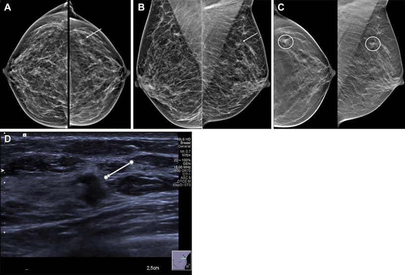 Images in a 54-year-old woman show a palpable lump in the right breast and an...