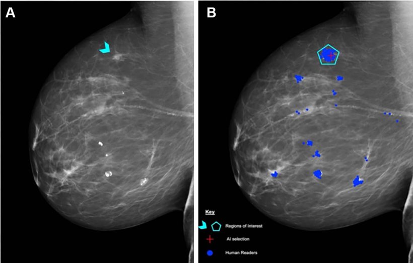 A: Right mediolateral oblique unadulterated mammogram shows an 8-mm ill-defined...