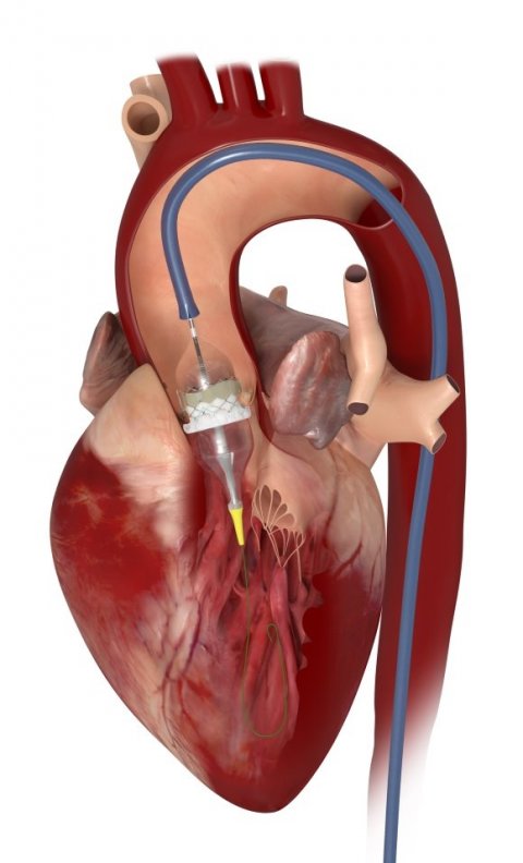 cardiac catheter placing tavi implant