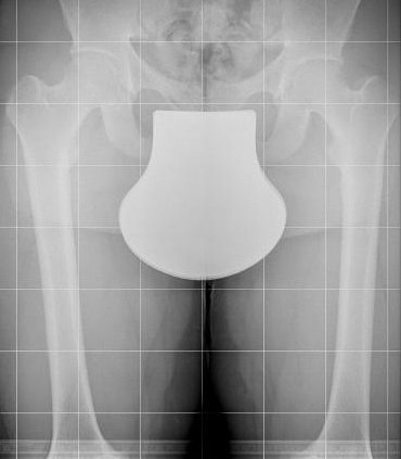 xray of lower extremities with cover from radiation shield