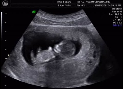 ultrasound image of fetus in the womb