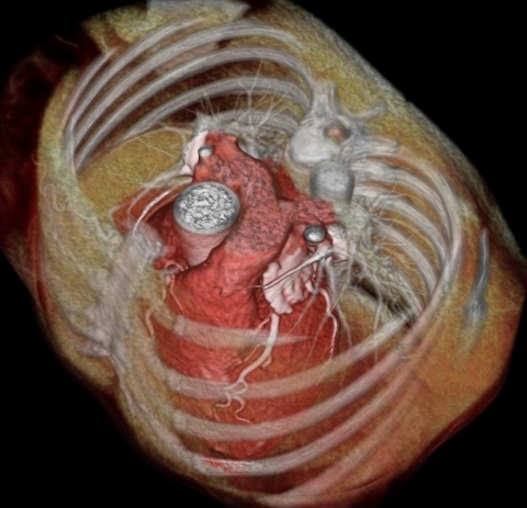 Cardiac CT with 3D reconstruction of the chest.