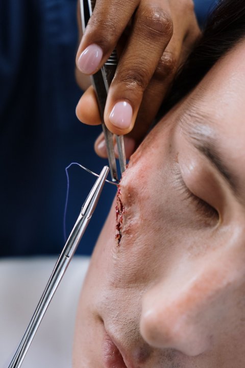 sewing of a facial scar